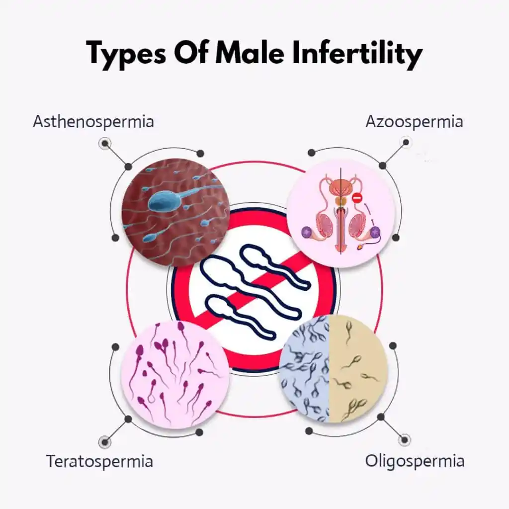 Four Primary Types of Male Infertility: Asthenospermia, Azoospermia, Teratospermia, Oligospermia