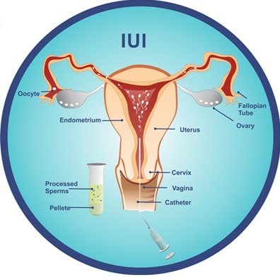 IUI Laboratory Sperm Processing and Fertilization Mechanism