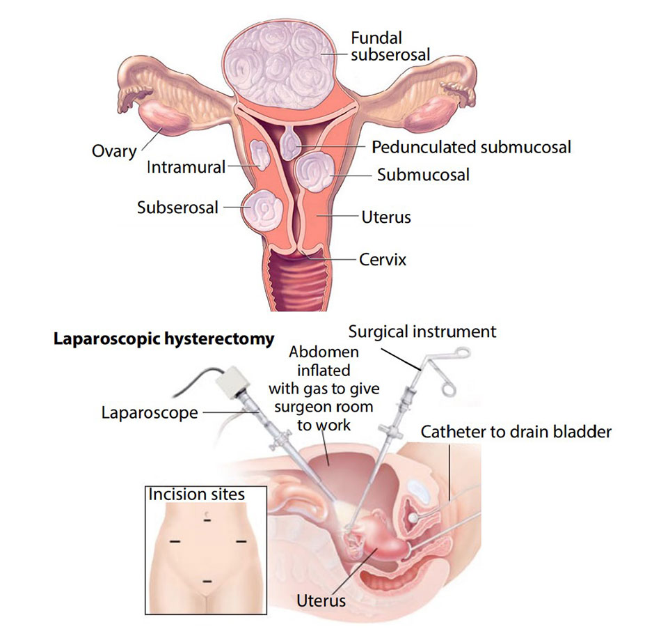 Laparoscopic In-Bag Morcellation Technique for Safe Fibroid Removal