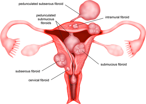 Laparoscopic Surgery and Keyhole Tissue Removal Architecture