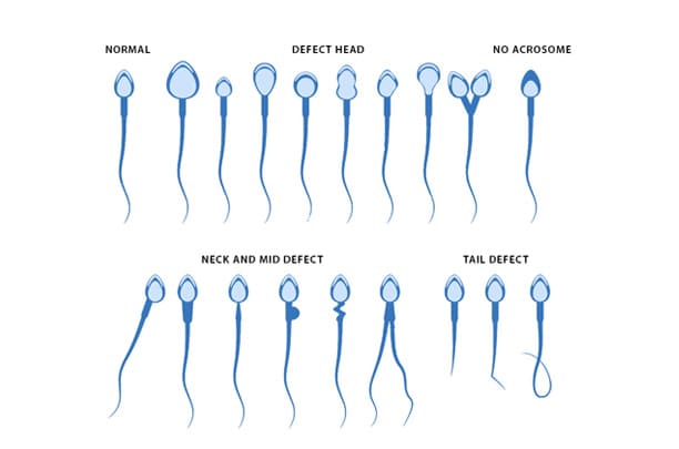 Sperm Morphology Defect Evaluation: Head, Neck, Midpiece and Tail Abnormalities